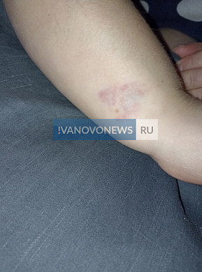 В Иванове агрессивная бездомная собака покусала шпица и его хозяйку